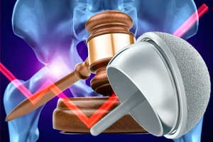 DePuy hip implant device lawsuit