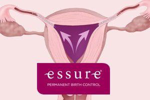 essure_birth_control_system_risks