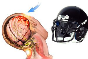 helmet_safety_concussion_risks