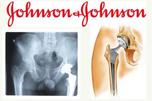 johnson-and-jonson-hip-settlement