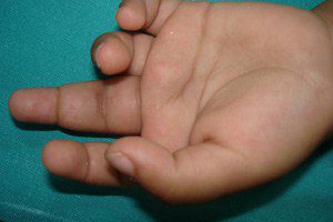 Antibiotics Associated with Increased Risk of Juvenile Arthritis