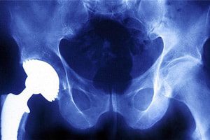 metal-on-metal-implant-hip-symptoms