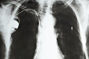Premature Battery Depletion of Defibrillator Caused 2 Deaths