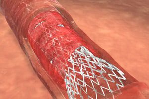 stent_implants_complications_deaths