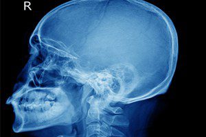 Car accident attorneys discuss head injuries