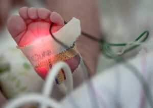 A blood-oxygen monitor is attached to the foot of an opioid-addicted baby