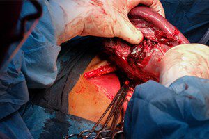 Ruptured spleen injuries caused in motor vehicle accidents
