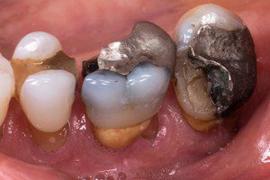 Dental amalgam mercury lawsuits