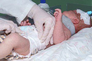 What are the most common causes of birth injuries?