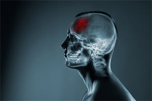 Understand brain injury lawsuits