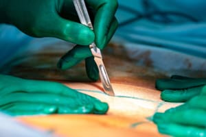 Roux-en-y laparoscopic gastric bypass lawsuits