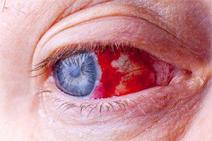 New eye damage studies link elmiron to vision damage
