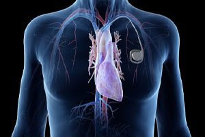 Boston scientific cardiac resynchronization therapy pacemaker lawsuits