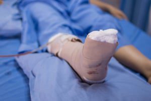 Exactech vantage total ankle implant lawsuits
