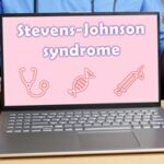 Stevens-johnson syndrome lawsuit lawyers 