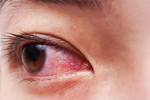 Eye infection caused by ezricare eye drops posed a risk prior to cdc’s warning