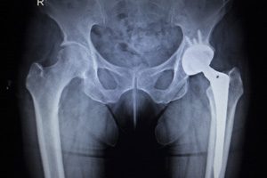 Modified Synovo Hip Replacement Systems Lawsuits