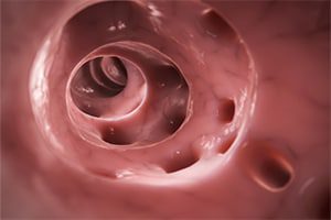 Ozempic Intestinal Blockage Lawsuits