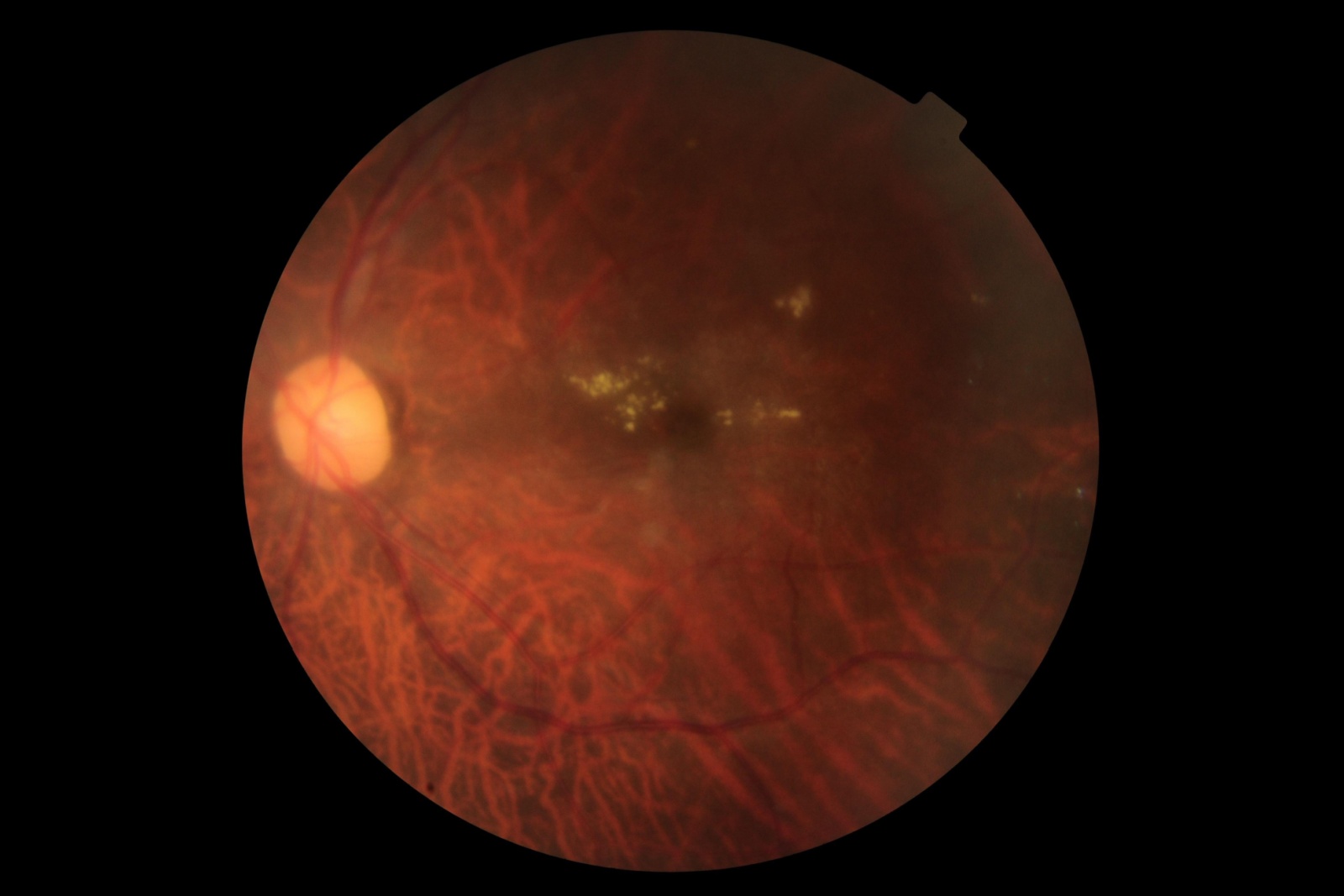 patients who developed optic nerve disorders after using GLP-1 medications